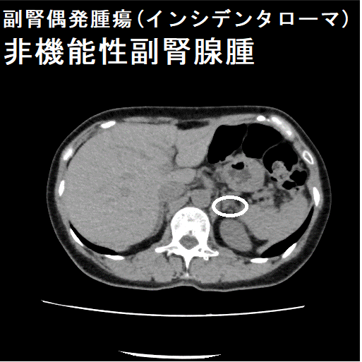 副腎偶発腫瘍(インシデンタローマ)非機能性副腎腺腫 副腎偶発腫瘍(インシデンタローマ)非機能性副腎腺腫