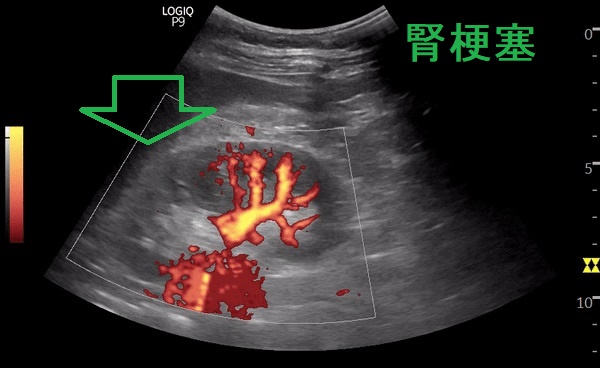 腎梗塞 超音波(エコー)画像 腎梗塞 超音波(エコー)画像