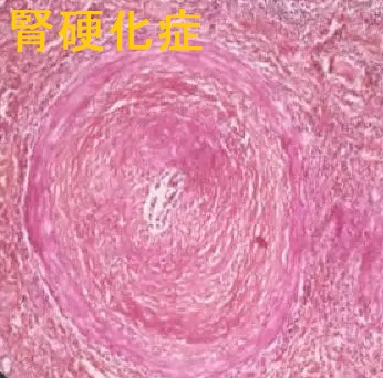 腎硬化症 腎硬化症