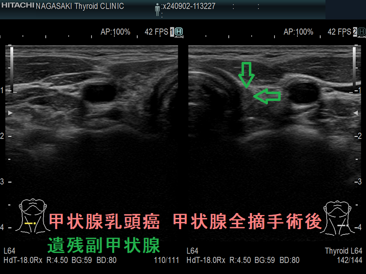 甲状腺乳頭癌 甲状腺全摘手術後 遺残副甲状腺 甲状腺乳頭癌 甲状腺全摘手術後 遺残副甲状腺1