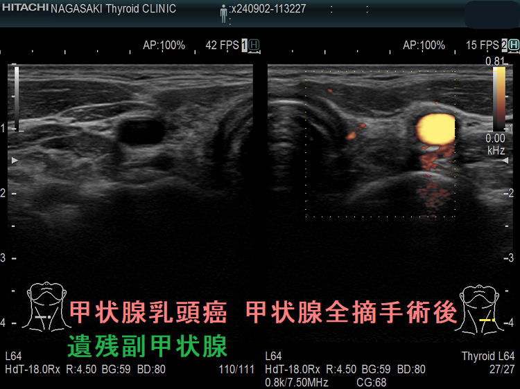 甲状腺乳頭癌 甲状腺全摘手術後 遺残副甲状腺 ドプラーモード 甲状腺乳頭癌 甲状腺全摘手術後 遺残副甲状腺 ドプラーモード