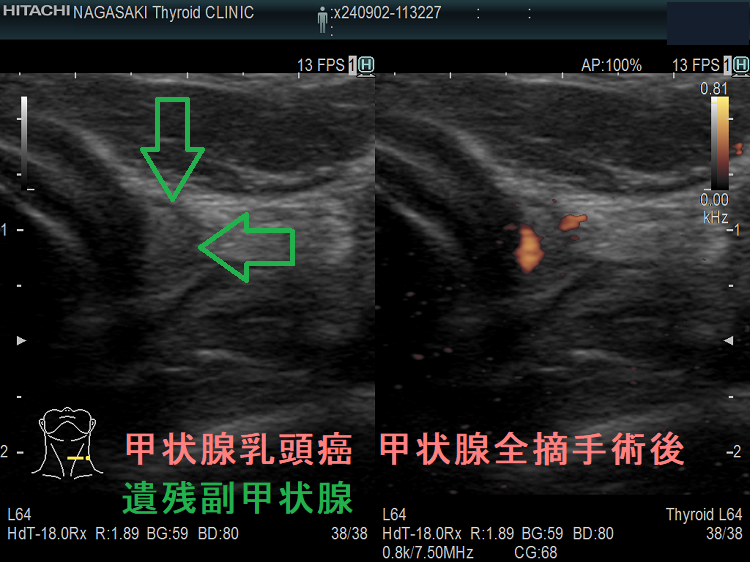甲状腺乳頭癌 甲状腺全摘手術後 遺残副甲状腺(拡大) 甲状腺乳頭癌 甲状腺全摘手術後 遺残副甲状腺(拡大)