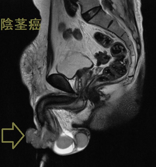 陰茎癌 T2強調画像 陰茎癌 T2強調画像
