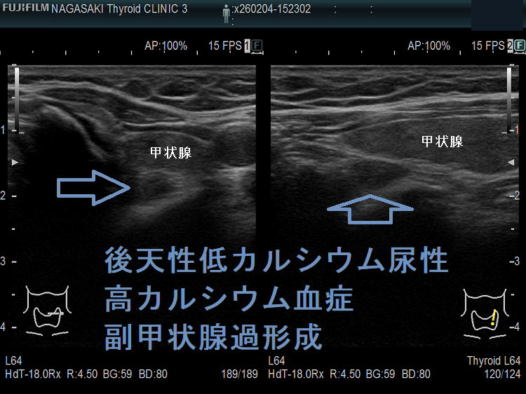 後天性低カルシウム尿性高カルシウム血症 副甲状腺過形成 後天性低カルシウム尿性高カルシウム血症 副甲状腺過形成