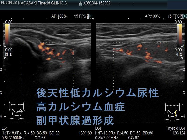 後天性低カルシウム尿性高カルシウム血症 副甲状腺過形成 ドプラーモード 後天性低カルシウム尿性高カルシウム血症 副甲状腺過形成 ドプラーモード
