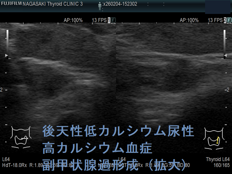 後天性低カルシウム尿性高カルシウム血症 副甲状腺過形成 (拡大) 後天性低カルシウム尿性高カルシウム血症 副甲状腺過形成 (拡大)