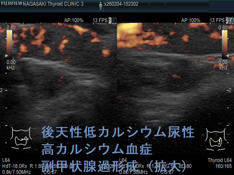 後天性低カルシウム尿性高カルシウム血症 副甲状腺過形成 (拡大) ドプラーモード 後天性低カルシウム尿性高カルシウム血症 副甲状腺過形成 (拡大) ドプラーモード