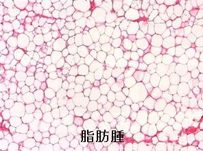頚部脂肪腫 組織 頚部脂肪腫 組織