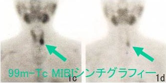 99m-Tc MIBIシンチグラフィー 99m-Tc MIBIシンチグラフィー
