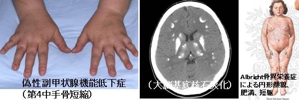 偽性副甲状腺機能低下症 偽性副甲状腺機能低下症