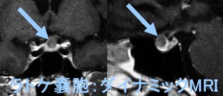 ラトケ嚢胞 ダイナミックMRI画像 ラトケ嚢胞 ダイナミックMRI画像