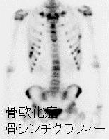 くる病/骨軟化症 骨シンチグラフィー くる病/骨軟化症 骨シンチグラフィー