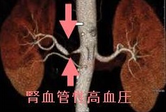 腎血管性高血圧 腎血管性高血圧