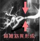 線維筋異形成 線維筋異形成