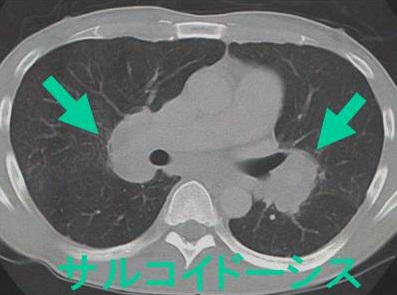 肺サルコイドーシスの胸部CT画像 肺サルコイドーシスの胸部CT画像