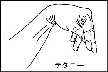 トルーソー徴候(Trousseau)徴候(助産師手位) トルーソー徴候(Trousseau)徴候(助産師手位)