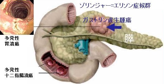 膵内分泌腫瘍(ガストリノーマ) 膵内分泌腫瘍(ガストリノーマ)