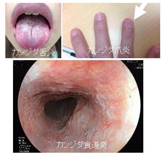 慢性粘膜皮膚カンジダ症 慢性粘膜皮膚カンジダ症