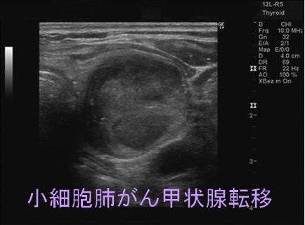小細胞肺がん甲状腺転移 超音波(エコー)画像 小細胞肺がん甲状腺転移 超音波(エコー)画像