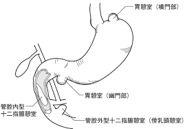 左副腎偶発腫瘍(インシデンタローマ)に見えても、実は胃憩室 左副腎偶発腫瘍(インシデンタローマ)に見えても、実は胃憩室