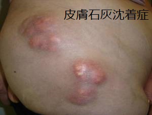 皮膚石灰沈着症 皮膚石灰沈着症