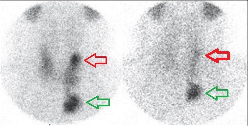 甲状腺分化癌(乳頭癌、濾胞癌)でも初期相は集積あり 甲状腺分化癌(乳頭癌、濾胞癌)でも初期相は集積あり