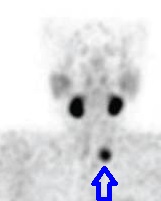 濾胞癌の集積 濾胞癌の集積