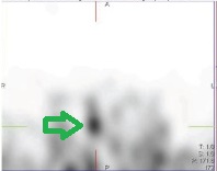 濾胞癌切除後現れた集積 濾胞癌切除後現れた集積