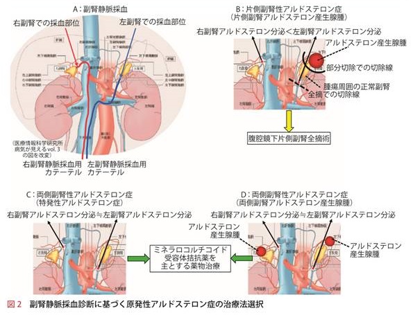 副腎静脈サンプリングに基ずく治療方針 副腎静脈サンプリングに基ずく治療方針