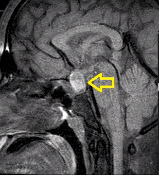 下垂体膿瘍 造影MRI 下垂体膿瘍 造影MRI