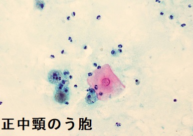 正中頸のう胞の穿刺細胞診 正中頸のう胞の穿刺細胞診