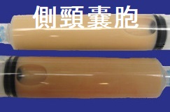 側頸嚢胞 穿刺液 側頸嚢胞 穿刺液