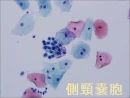 側頸嚢胞 細胞診 側頸嚢胞 細胞診