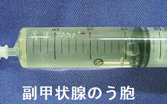 副甲状腺のう胞 穿刺液 副甲状腺のう胞 穿刺液