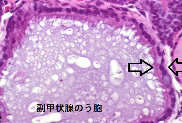 副甲状腺のう胞 病理組織 副甲状腺のう胞 病理組織