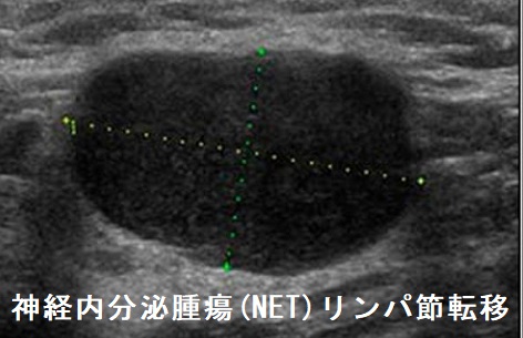 神経内分泌腫瘍 (NET)リンパ節転移 超音波(エコー)画像 神経内分泌腫瘍 (NET)リンパ節転移 超音波(エコー)画像