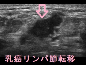 乳癌 リンパ節転移 超音波(エコー)画像 乳癌 リンパ節転移 超音波(エコー)画像