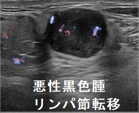 悪性黒色腫 リンパ節転移 超音波(エコー)画像 悪性黒色腫 リンパ節転移 超音波(エコー)画像