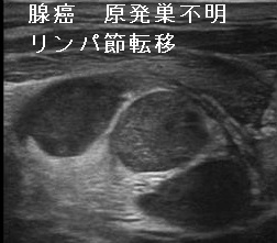 腺癌 原発巣不明 リンパ節転移 超音波(エコー)画像 腺癌 原発巣不明 リンパ節転移 超音波(エコー)画像