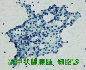 副甲状腺腺腫 細胞診 弱拡大 副甲状腺腺腫 細胞診 弱拡大