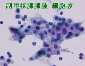 副甲状腺腺腫 細胞診 副甲状腺腺腫 細胞診