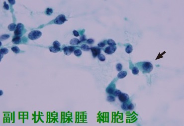 副甲状腺腺腫 細胞診(異型細胞) 副甲状腺腺腫 細胞診(異型細胞)