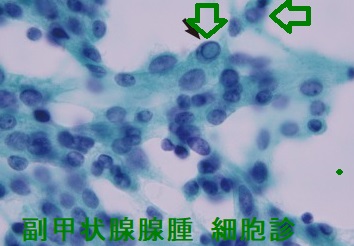 副甲状腺腺腫 細胞診 (核内封入体) 副甲状腺腺腫 細胞診 (核内封入体)