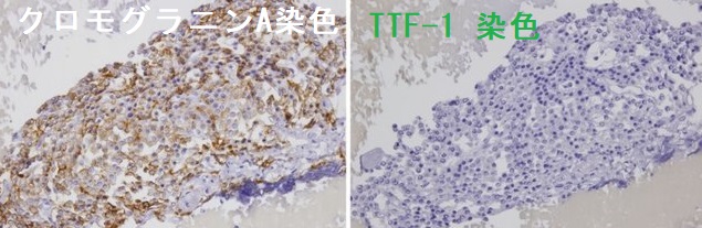 副甲状腺腺腫 細胞診 (クロモグラニンA染色、TTF-1染色) 副甲状腺腺腫 細胞診 (クロモグラニンA染色、TTF-1染色)