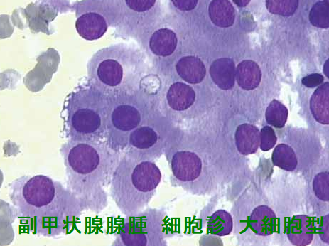 副甲状腺腺腫 細胞診 大細胞型 副甲状腺腺腫 細胞診 大細胞型