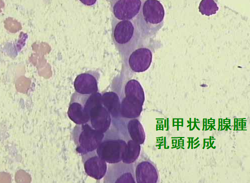 副甲状腺腺腫 細胞診 乳頭形成 副甲状腺腺腫 細胞診 乳頭形成