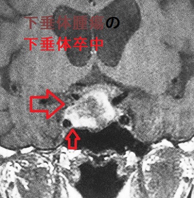 下垂体腫瘍の下垂体卒中 下垂体腫瘍の下垂体卒中