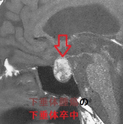 下垂体腫瘍の下垂体卒中 下垂体腫瘍の下垂体卒中