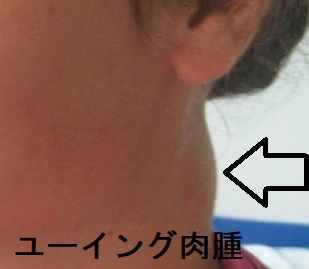 ユーイング肉腫 ユーイング肉腫