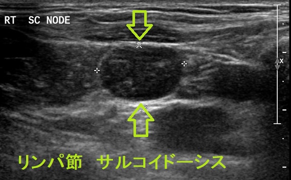 リンパ節 サルコイドーシス リンパ節 サルコイドーシス
